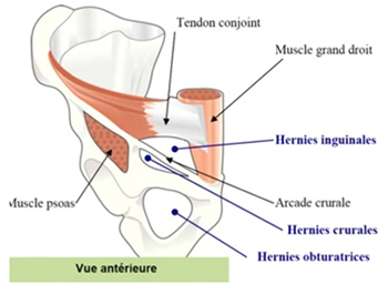 Diagnostic d'une hernie inguinale | Institut de la Paroi